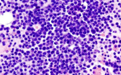 Latest technology can identify Multiple Myeloma cells faster than ever