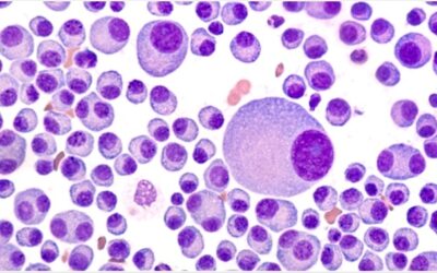 New Therapies for Blood Cancers Hold Promise