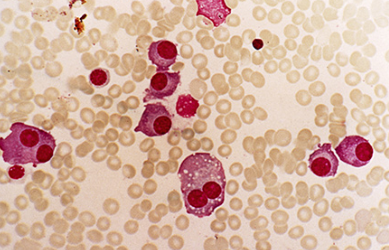 “Good-Risk” Group of Patients With Myeloma Saw Better Outcomes