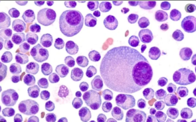 Multiple myeloma is not easily diagnosed.